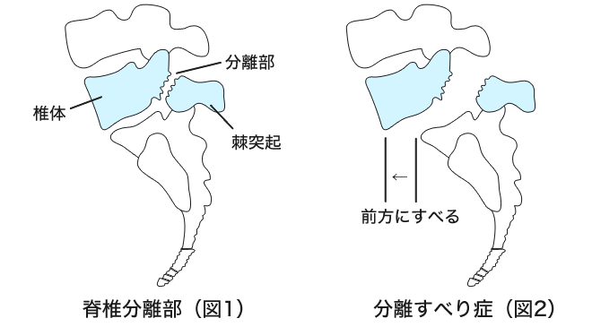 脊椎分離症とすべり症
