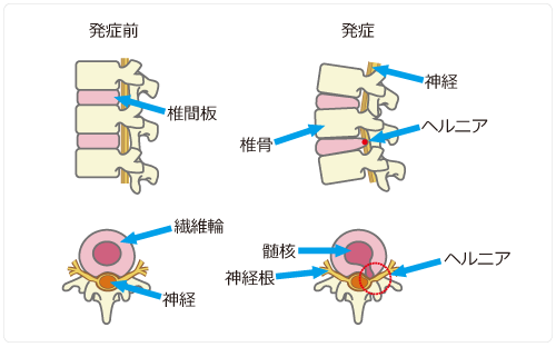 椎間板ヘルニア発症前と発症時