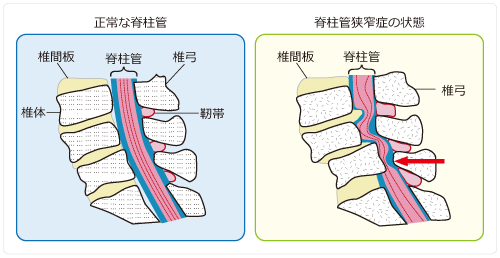 正常な脊柱管と脊柱管狭窄症の状態